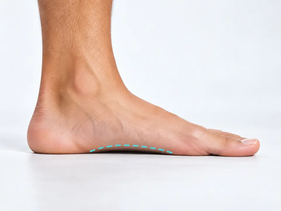 Side view of a low foot arch while standing