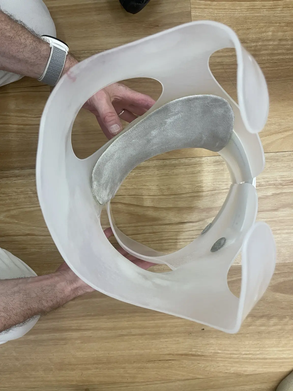 A patient-specific scoliosis brace made and fitted by Wonderwalk