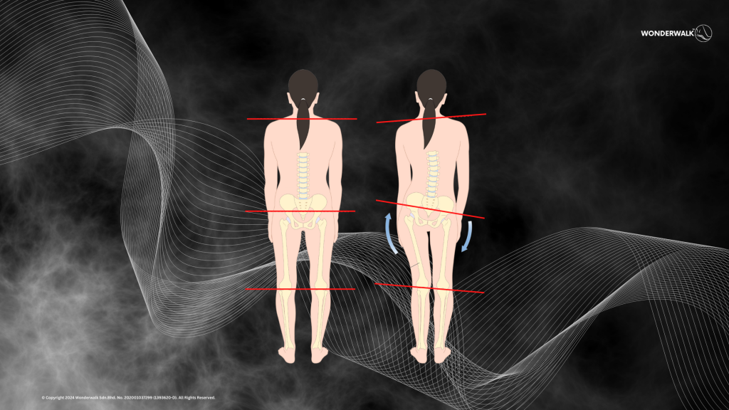 Diagram comparing normal posture and posture affected by flat feet. The image shows how flat feet cause misalignment in the body, leading to uneven shoulders, tilted hips, and inward-leaning legs, resulting in poor overall posture.