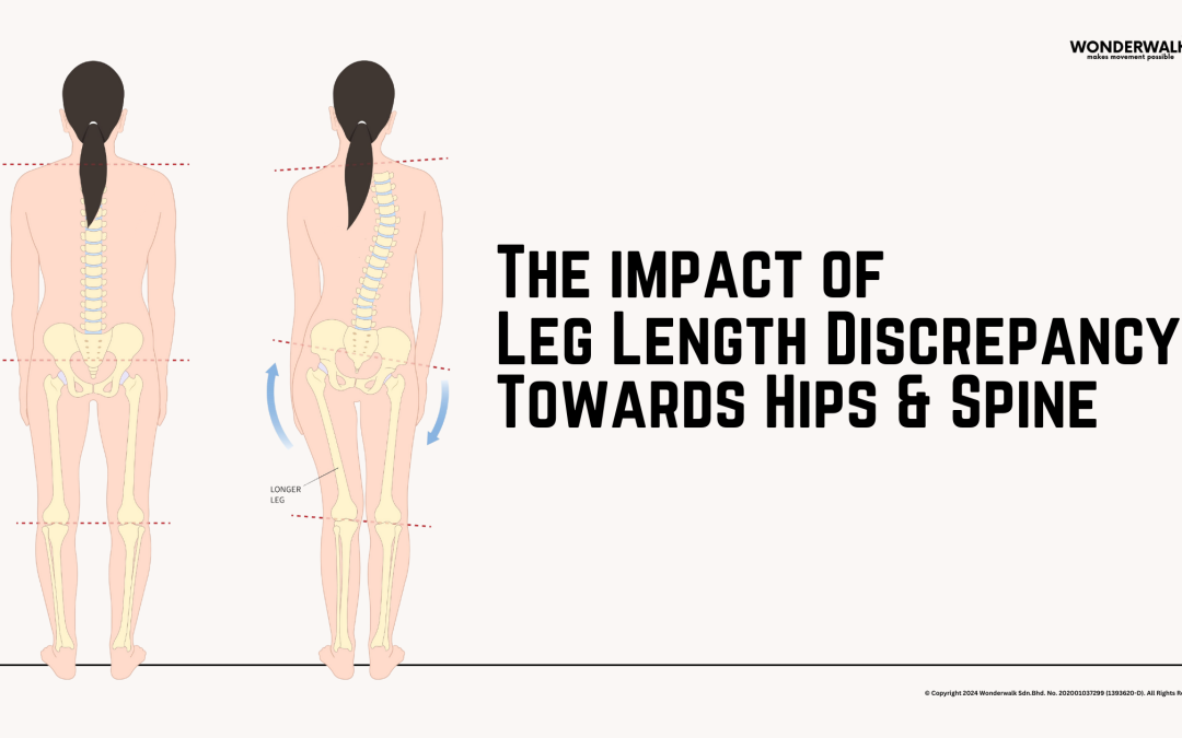 Leg Length Discrepancy and Scoliosis: Understanding the Connection