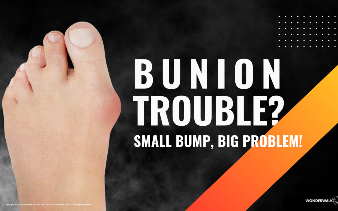 Bunions: Don’t Let a Small Problem Become a Big Issue