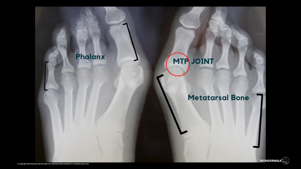 X-ray of a foot showing the Metatarsophalangeal (MTP) joint, phalanx, and metatarsal bone, illustrating the anatomy related to bunion development.