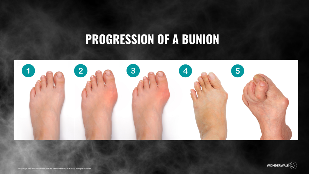 Image depicting the progression of a bunion from mild to severe stages, illustrating how untreated bunions can worsen over time