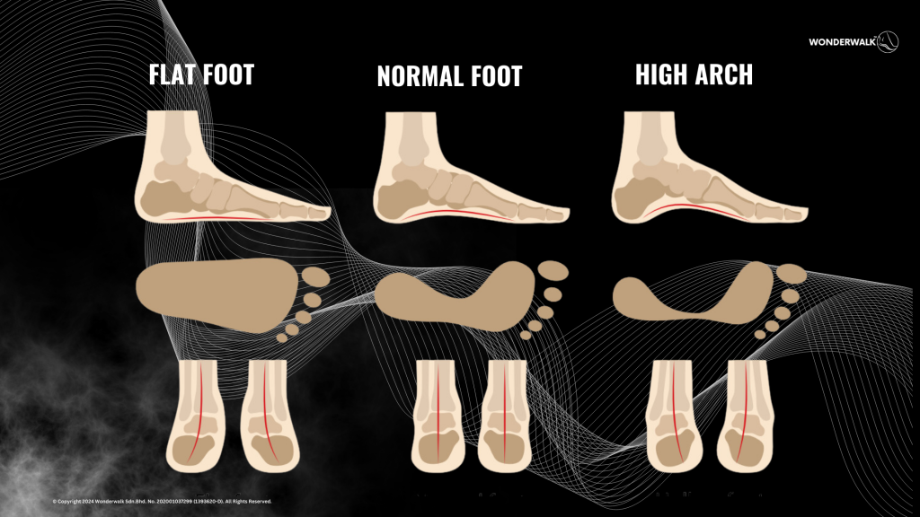 Comparison of three foot types: flat foot, normal foot, and high arch. The image illustrates the differences in arch height and the resulting footprint and alignment for each type. Flat foot shows a low or collapsed arch, normal foot has a standard arch, and high arch displays an elevated arch with minimal contact with the ground.